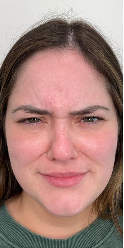 Botox Before & After Image