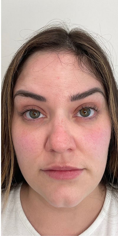 Botox Before & After Image