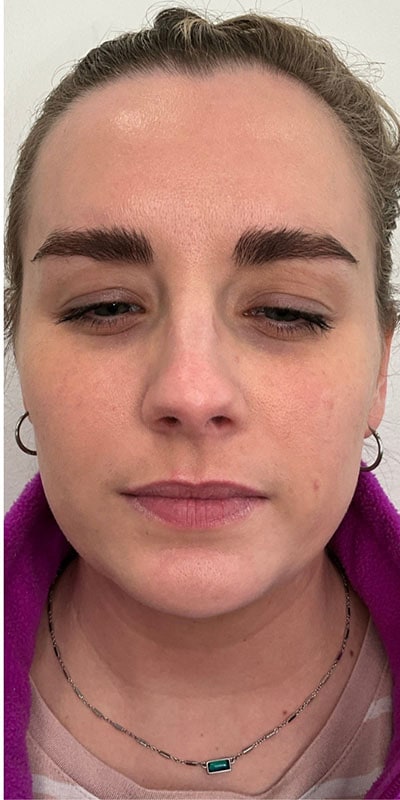 Botox Before & After Image