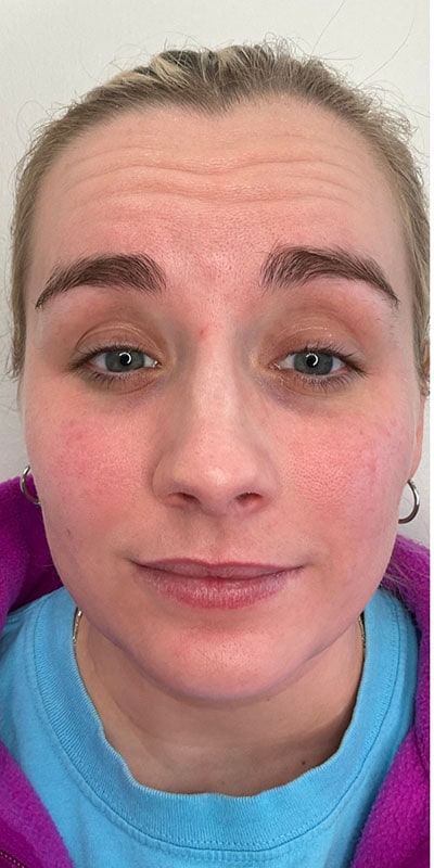 Botox Before & After Image