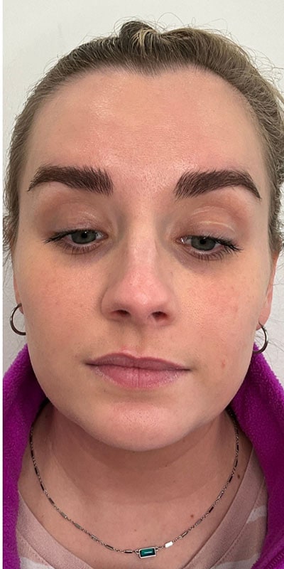 Botox Before & After Image