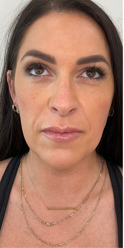 Cheek Fillers Before & After Image