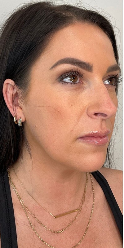 Cheek Fillers Before & After Image