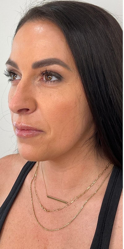 Cheek Fillers Before & After Image