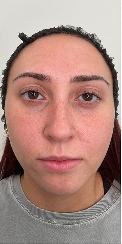 Chin Fillers Before & After Image