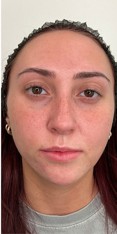 Chin Fillers Before & After Image