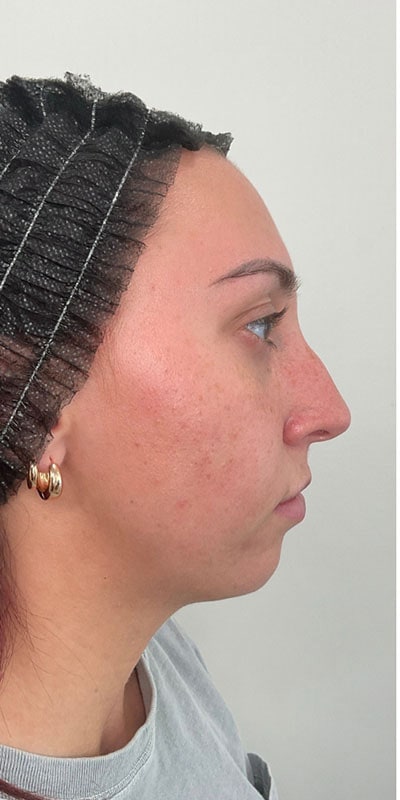 Chin Fillers Before & After Image