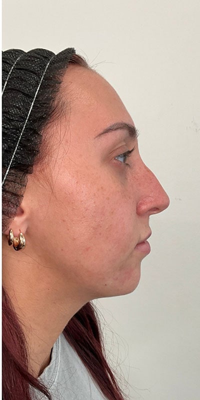 Chin Fillers Before & After Image