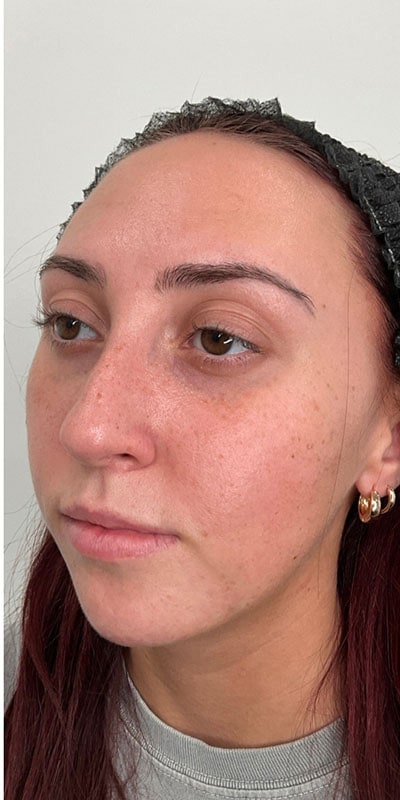 Chin Fillers Before & After Image