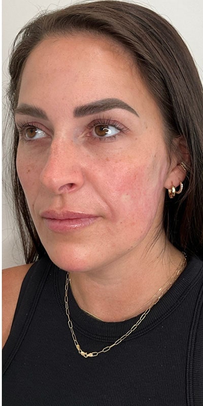 Chin Fillers Before & After Image