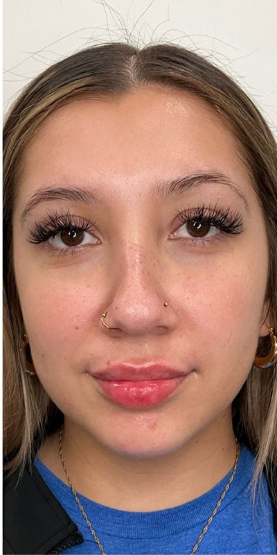 Lip Fillers Before & After Image