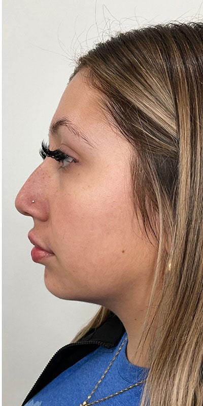 Lip Fillers Before & After Image