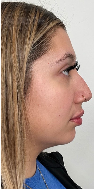 Lip Fillers Before & After Image