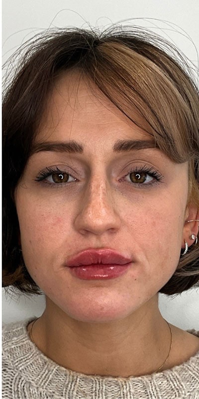 Lip Fillers Before & After Image