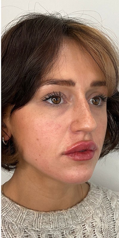 Lip Fillers Before & After Image