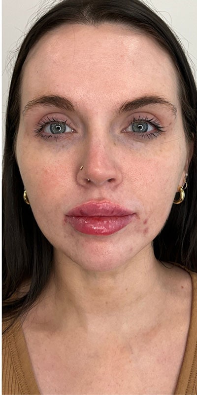 Lip Fillers Before & After Image