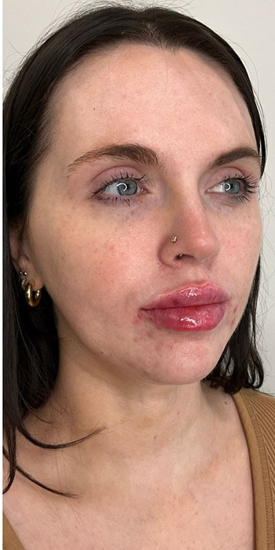 Lip Fillers Before & After Image