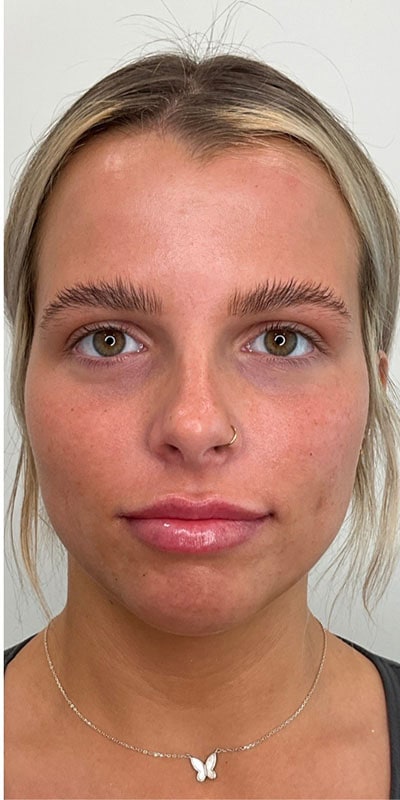 Lip Fillers Before & After Image