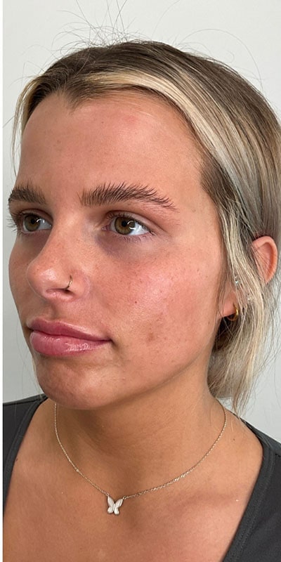 Lip Fillers Before & After Image