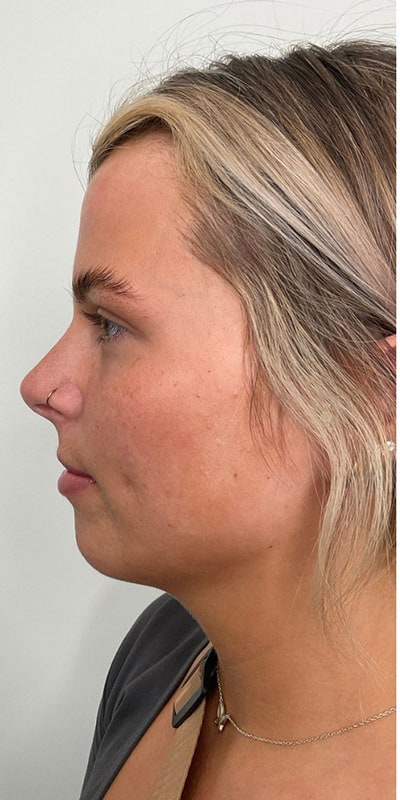 Lip Fillers Before & After Image