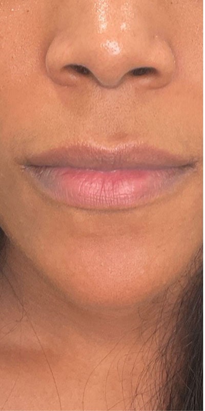 Lip Fillers Before & After Image