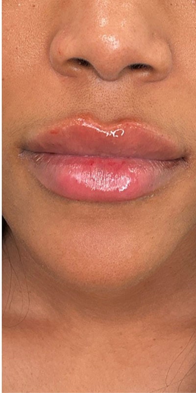 Lip Fillers Before & After Image