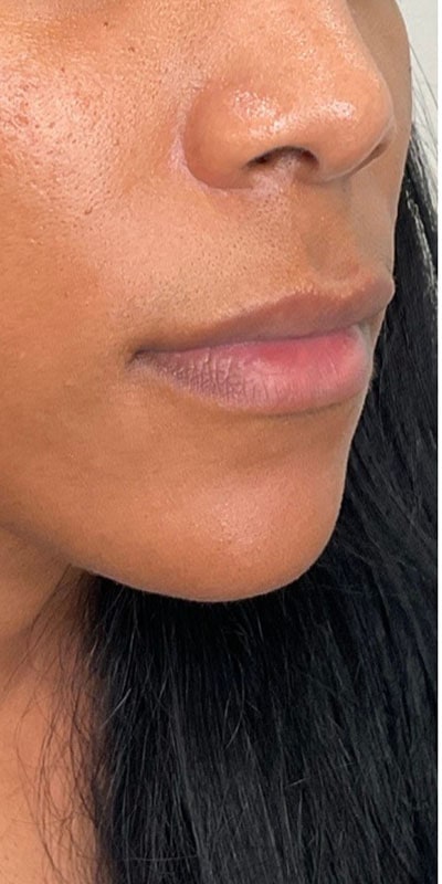 Lip Fillers Before & After Image