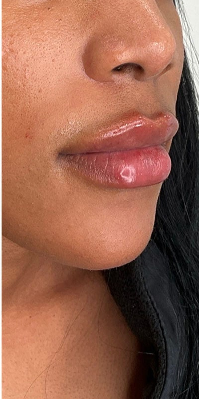 Lip Fillers Before & After Image