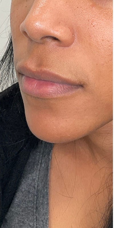 Lip Fillers Before & After Image