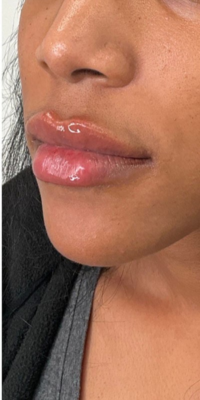 Lip Fillers Before & After Image