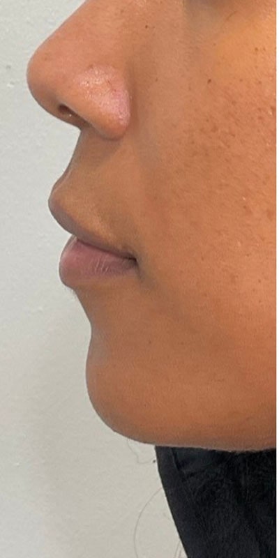 Lip Fillers Before & After Image