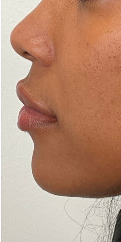 Lip Fillers Before & After Image