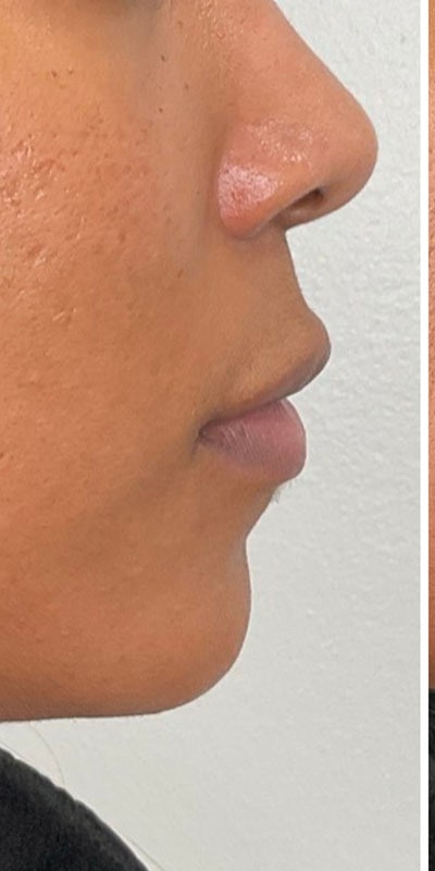 Lip Fillers Before & After Image