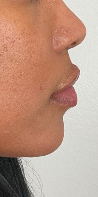 Lip Fillers Before & After Image