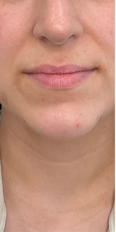 Lip Fillers Before & After Image