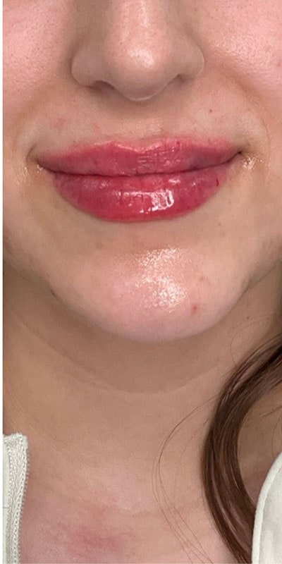 Lip Fillers Before & After Image