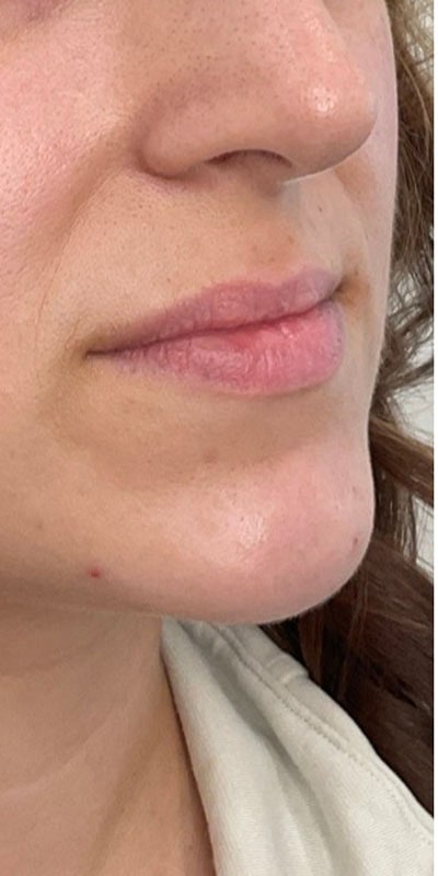 Lip Fillers Before & After Image