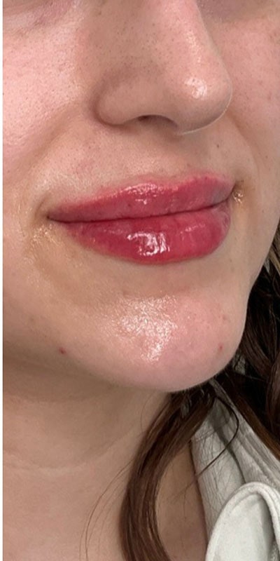 Lip Fillers Before & After Image