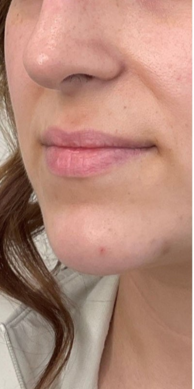 Lip Fillers Before & After Image