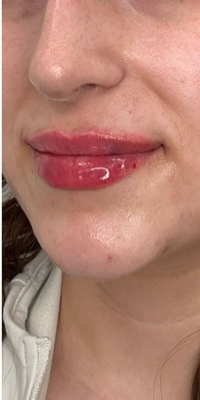 Lip Fillers Before & After Image