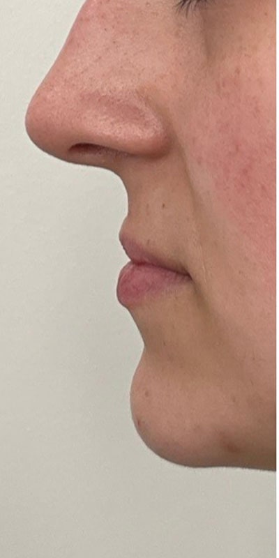 Lip Fillers Before & After Image