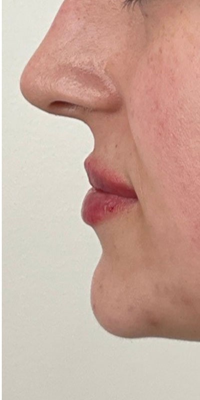 Lip Fillers Before & After Image