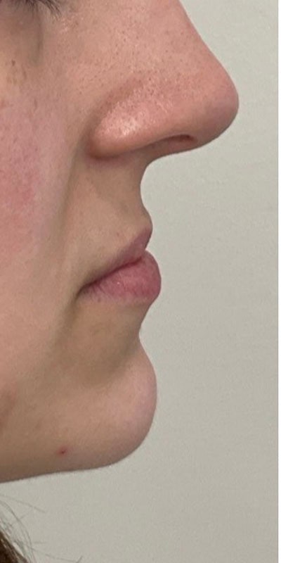 Lip Fillers Before & After Image