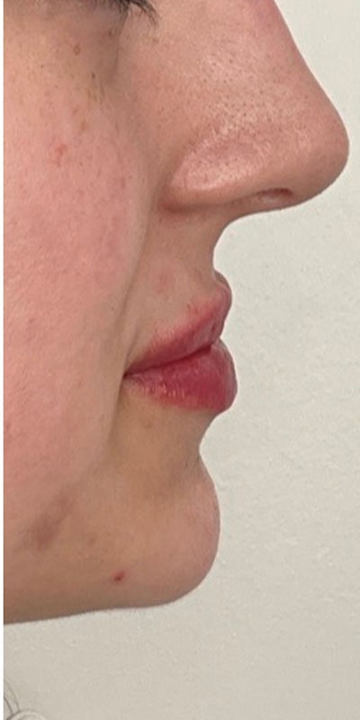 Lip Fillers Before & After Image