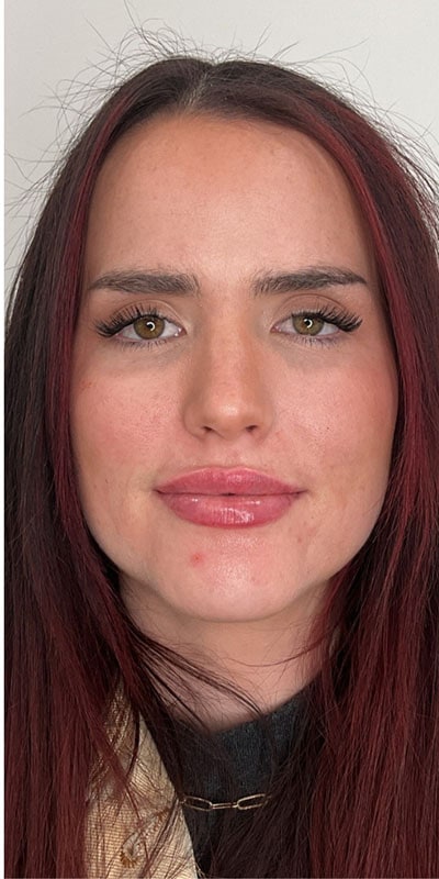 Lip Fillers Before & After Image