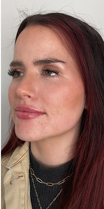 Lip Fillers Before & After Image